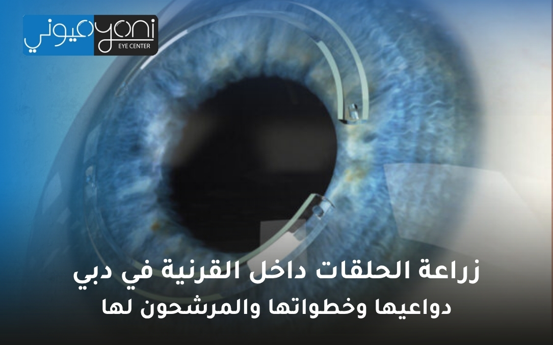 زراعة الحلقات داخل القرنية في دبي