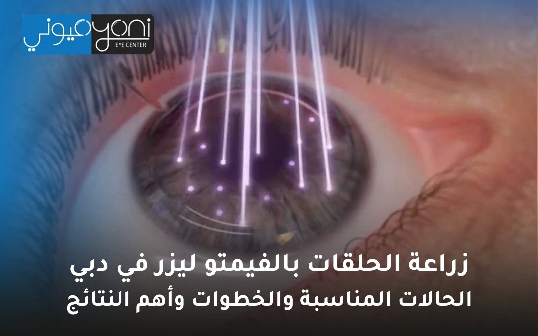 زراعة الحلقات بالفيمتو ليزر في دبي زراعة الحلقات بالفيمتو ليزر في دبي